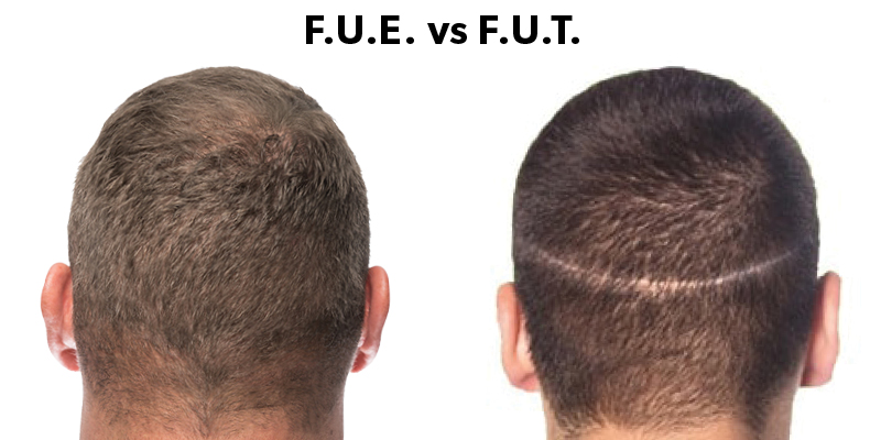 تفاوت اصلی روش های FIT و FUT