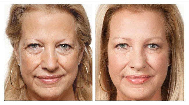 جوانسازی پوست و درمان چروک های صورت و گردن با استفاده از پی آر پی PRP